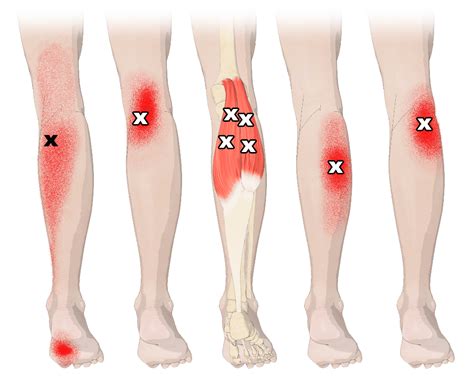 Hamstring And Calf Issues D2jsp Topic