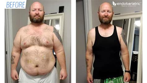 Gastric Bypass Before And After Pictures Men Gastric