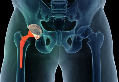 What’s Behind The Amazing Accuracy Of Joint Replacement