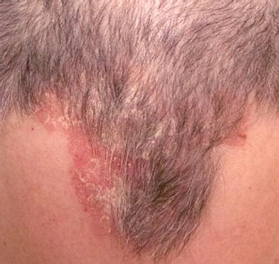 itchy scalp dry hair loss  treatment remedy diseases pictures