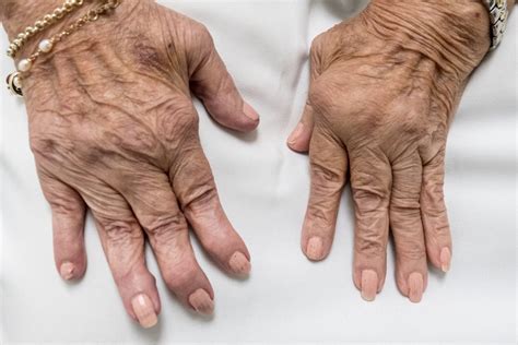 early treatment counters joint damage  rheumatoid arthritis