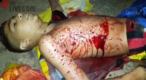 Bleeding To Death From A Gunshot Wound To The Stomach