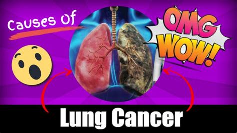 Causes Of Lung Cancer What Causes Lung Cancer Male Health Clinic