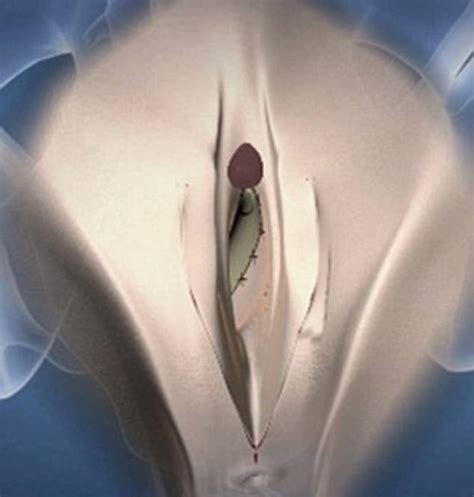 forced vaginoplasty for men