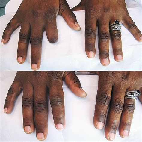 finger prosthesis hand prosthesis milwaukee wi — life like prosthetics