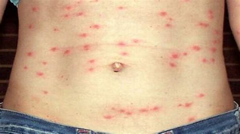 typhus causes symptoms diagnosis and treatment natural