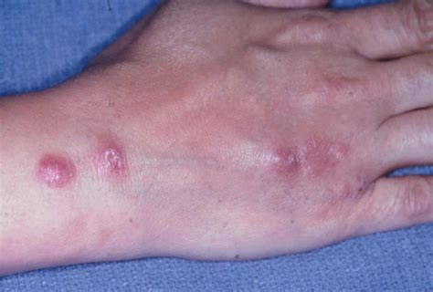 sporotrichosis  symptoms rash diagnosis treatment