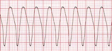 wide complex tachycardia training acls cardiac rhythms video proacls