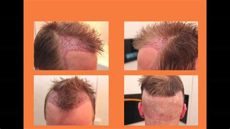 whtc fue hair transplant unshaven recipient site dense packing