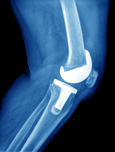 Knee Replacement X Ray The Orthopedic And Sports Medicine