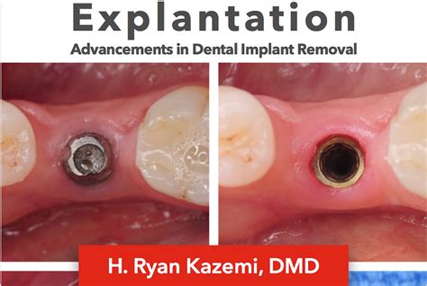 Explantation Dental Implant Removal Guide Ebook Kazemi