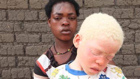 malawi albinos hunted and murdered for their limbs cbs news