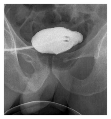 Posterior Urethra Rupture Contrast Enhanced Computed Tomography Scan