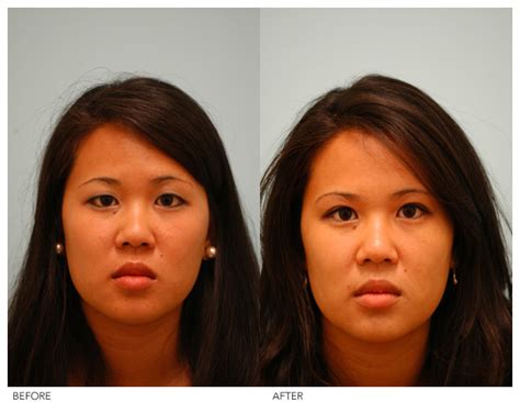 Does Asian Eyelid Surgery Represent A Loss Of Ethnic Identity Lam