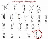Turner Karyotype Syndrom Genetic Chromosome Chromosomes Karyotyping Causes Diagnosis sketch template