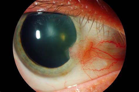 whitman images cin conjunctival intraepithelial neoplasia