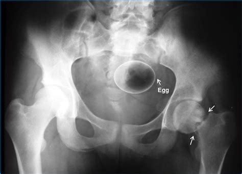 Worlds Worst Aande Sexual Misadventure X Rays Revealed From Coffee