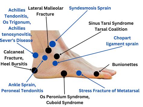 ultimate foot pain chart      medicure wise