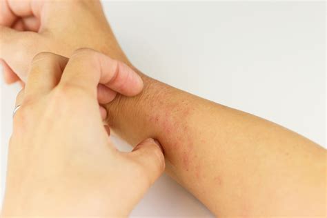 itchy skin  rashes  quick fixes dr livingood