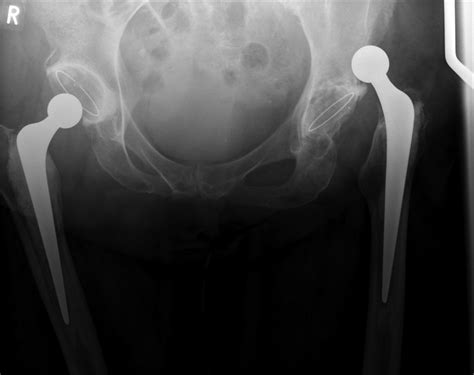Simultaneous Bilateral Total Hip Arthroplasty Dislocation With