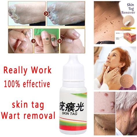 really work body warts corn mole genital wart treatment cream skin tag