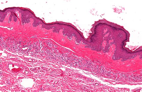 pathology outlines lichen sclerosus balanitis xerotica