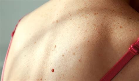 Skin Cancer Warning Signs