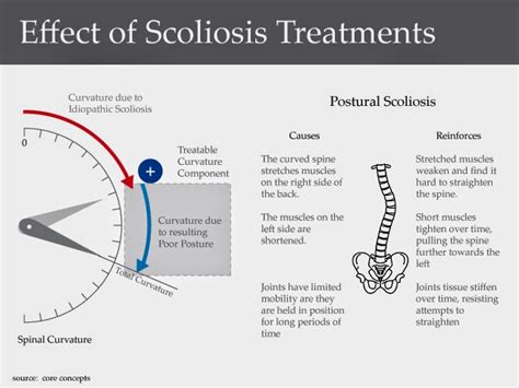 scoliosis treatment what is the treatment of symptoms and