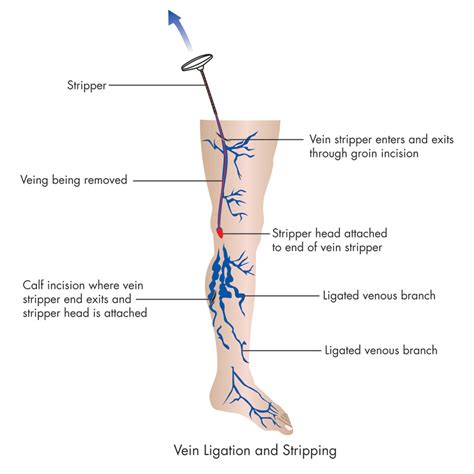 great saphenous vein  femoral vein modernhealcom