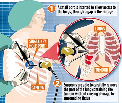 lung cancer cure fixes patients    days daily mail