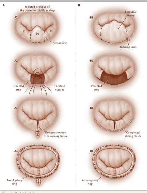 Figure 1 From Mitral Valve Repair For Mitral Valve Prolapse Semantic