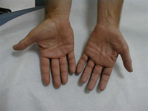 atrophie der kleinen handmuskulatur bei mito