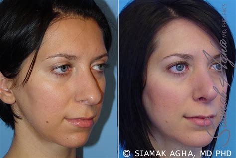 chin augmentation before and after photos patient 1