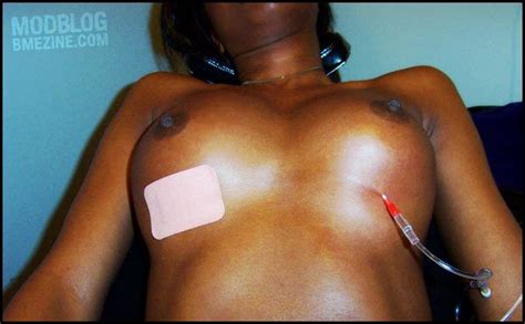 growing breast injection