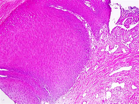 erosions on a prolapsed uterine in an old woman an unusual