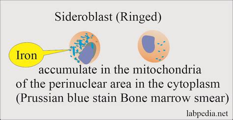 anemia part 9 sideroblastic anemia and anemia due to