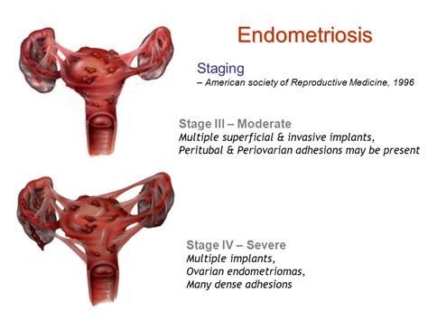 See 43 Facts Of Endometriosis Symptoms And Treatment They Missed To