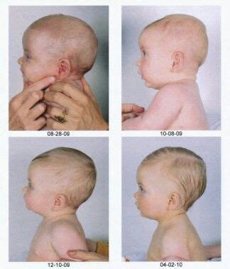 congenital synostosis anatomy projects human anatomy baby face