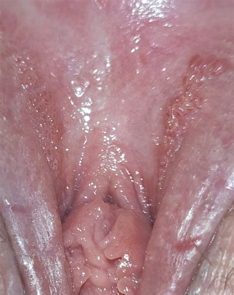 hpv or vp pleas help sexual health forums patient