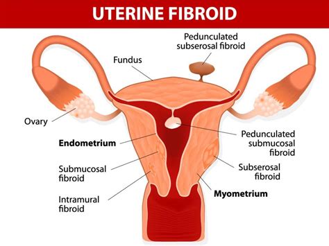Uterine Fibroids And Fertility Genetic Testing London Concept Fertility