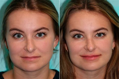 lip augmentation  chevy chase md patient