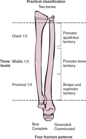 proximal radius fracture