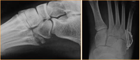 A Closer Look At Fixation For Fifth Metatarsal Fractures
