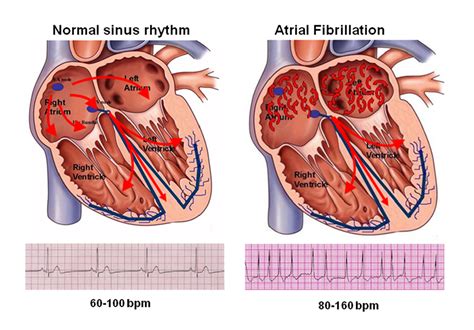 Understanding Atrial Fibrillation Heart Health Blogs