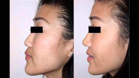 asian nose surgery before after sex archive