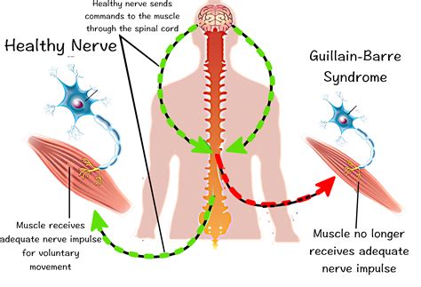 recovery  guillain barre syndrome orlando neuro therapy