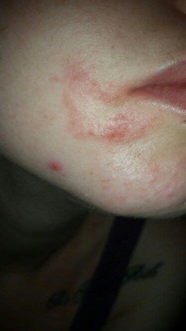 Does This Look Like Herpes Genital Herpes Simplex Infections