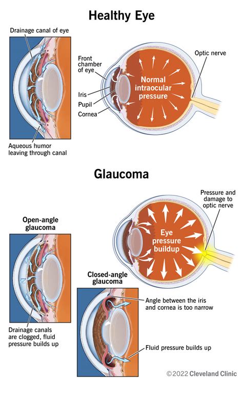 glaucoma symptoms  types treatment