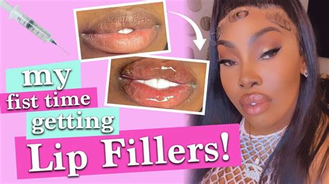 My First Time Getting Lip Filers Youtube