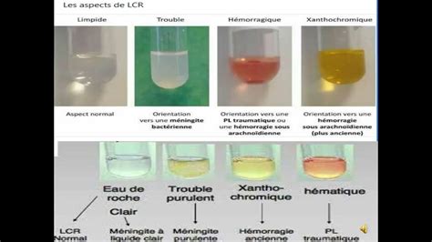 Examen Cytobactériologique Du Liquide Céphalorachidien Lcr Final Youtube